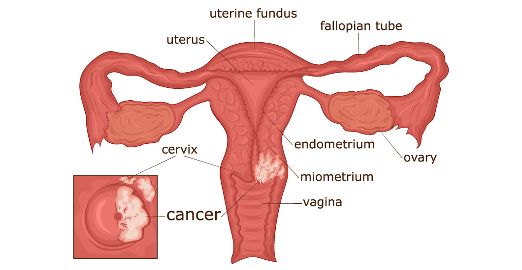 ¿Cómo prevenir el cáncer de cuello uterino?